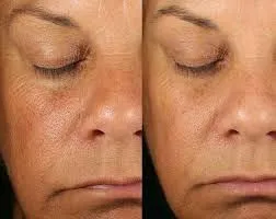 FESALC y la fotomedicina estética: cómo la luz refina la piel con precisión